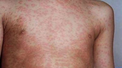 Nigeria, US CDC targets over 100m children for measles vaccination