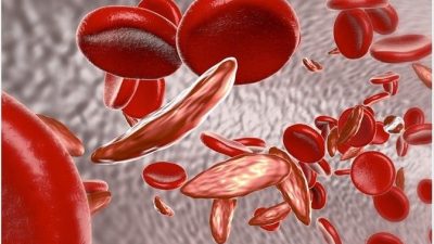 New partnership launched to improve sickle cell disease care in Sub-Saharan Africa