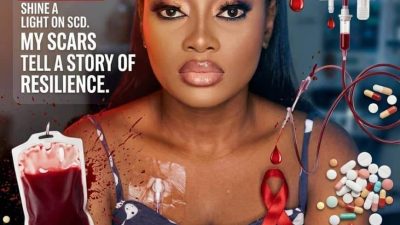 World Sickle Cell Day:  A warrior’s call to bridge treatment gaps, stigma