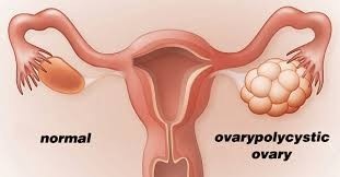 Understanding PCOS: Beyond Hormones and Periods