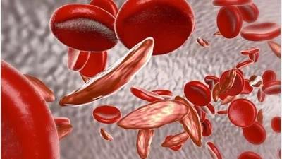 Reimagining Hope for People Living with Sickle Cell Disease in Africa