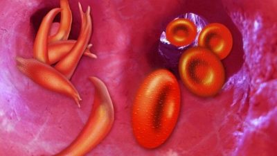 Foundation tasks Nigerians on correct information about sickle cell disease
